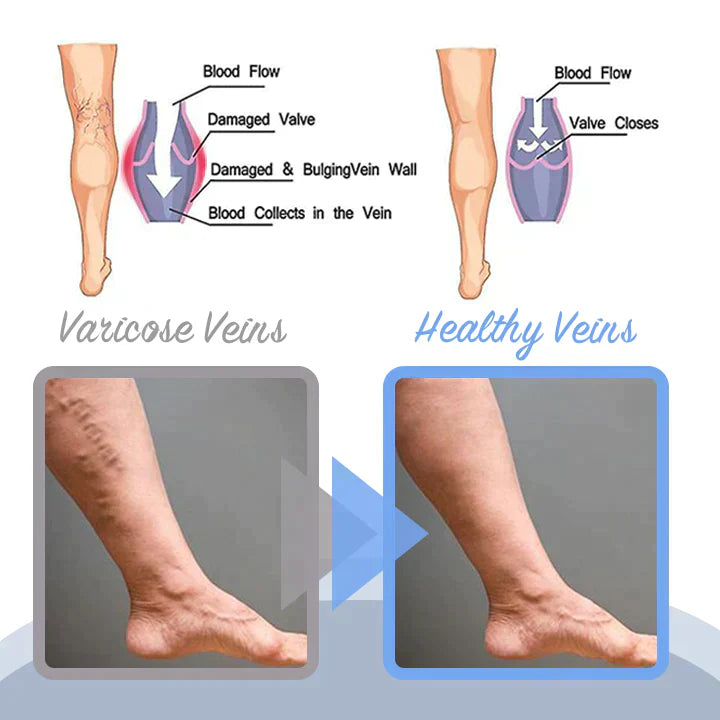 Lovild Varicose Veins Relief Spray