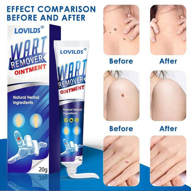 LOVILDS Wart Remover Ointment