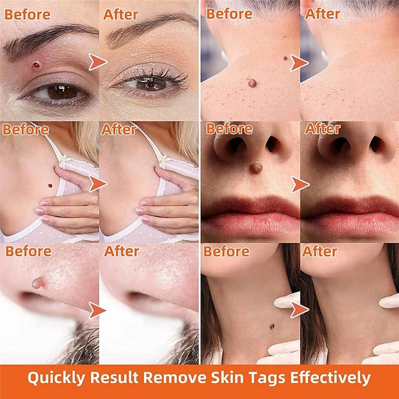 LOVILDS Wart Remover Ointment