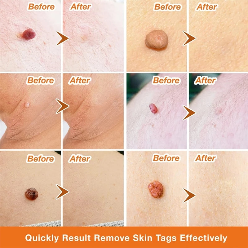 LOVILDS Wart Remover Ointment