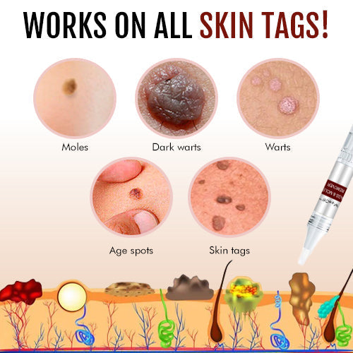Lovilds Tags and Moles Remover Cream