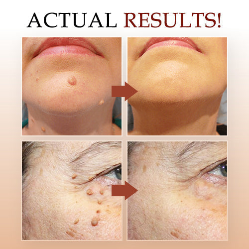Lovilds Tags and Moles Remover Cream